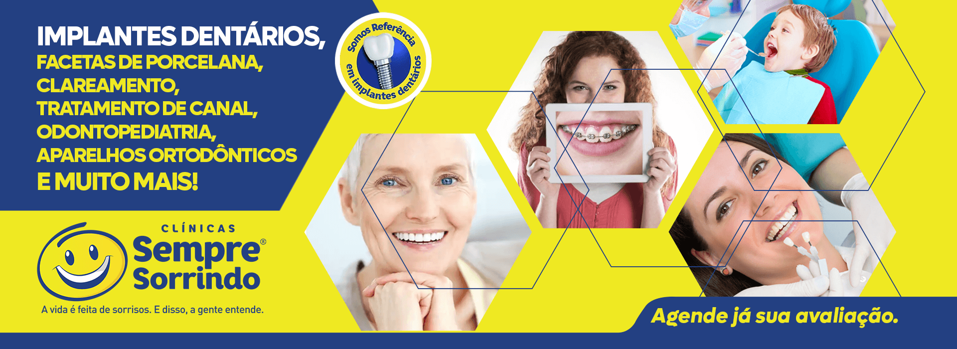 Implantes Dentários, Facetas de Porcelana, Clareamentoe muito mais na Clinica Sempre Sorrindo