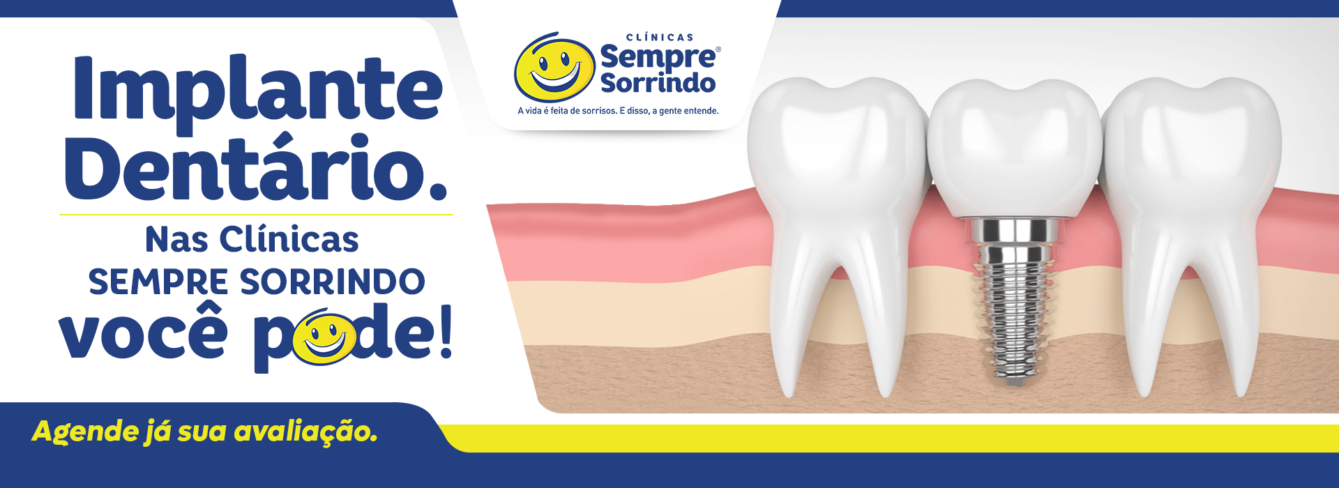 Implante Dentário na Clínica Sempre Sorrindo